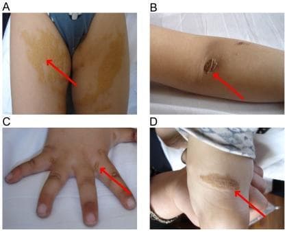 This composite of four clinical photographs (labeled A-D) illustrates the dermatological and musculoskeletal manifestations of Familial Hypercholesterolemia (FH) in a pediatric patient. Panel A displays large, bilateral, yellowish-tan cutaneous xanthomas on the buttocks and upper thighs, characterized by irregular borders and a plaque-like distribution. Panel B shows a distinct, yellowish-tan nodule with a roughened surface over the extensor surface of the elbow, consistent with a tuberous xanthoma. Panel C depicts the dorsal aspect of a hand with several small, raised, yellowish cutaneous xanthomas located on the fingers and interdigital webs. Panel D reveals a prominent, elongated yellowish nodule overlying the Achilles tendon, indicative of a tendinous xanthoma. Red arrows in each panel highlight the specific lesions. These clinical findings are hallmark physical signs of severe lipid metabolic disorders, representing localized accumulations of lipid-laden macrophages (foam cells) in the skin and tendons due to extreme hyperlipidemia.