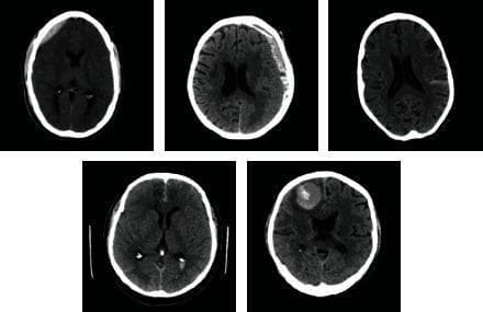 This composite diagnostic image features five axial non-contrast Computed Tomography (CT) scans of the human brain, illustrating various presentations of intracranial hemorrhage. The scans demonstrate distinct pathological features: 1) a hyperdense, biconvex (lens-shaped) collection consistent with an epidural hematoma in the left frontal region; 2) a crescent-shaped hyperdense collection along the cerebral hemisphere characteristic of a subdural hematoma; 3) a scan showing relatively normal brain parenchyma and ventricular system for comparison; 4) a scan exhibiting subtle hyperdensity within the cortical sulci indicative of subarachnoid hemorrhage; and 5) a focal, well-defined hyperdense intraparenchymal lesion in the right frontal lobe surrounded by a thin rim of hypodensity, representing an intraparenchymal hemorrhage with associated vasogenic edema. These images serve as educational examples for identifying different hemorrhage subtypes based on location, morphology, and density. The collection is highly relevant for neuroradiology training and the development of automated detection algorithms.