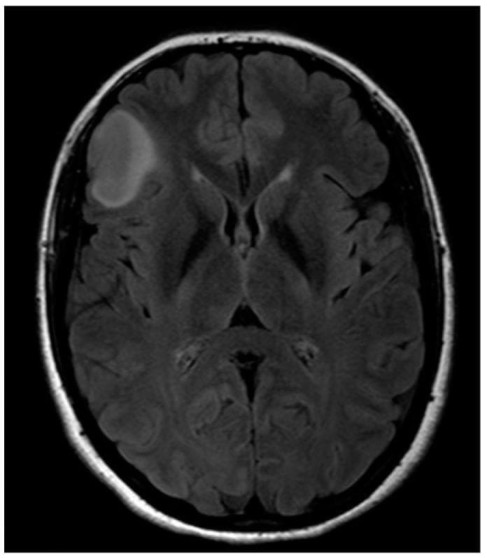 An axial MRI scan of the brain, utilizing Fluid-Attenuated Inversion Recovery (FLAIR) or T2-weighted sequencing, demonstrates a well-circumscribed hyperintense lesion in the right fronto-opercular region. The lesion is ovoid and relatively homogeneous, characteristic of a diffuse low-grade glioma, such as a low-grade astrocytoma. It is located near cortical areas involved in language and motor function, specifically the right-sided equivalent of Broca's area. While the lesion causes localized effacement of adjacent cortical sulci, there is no evidence of a significant midline shift, ventricular compression, or extensive peritumoral edema. The surrounding brain parenchyma, including the contralateral hemisphere and the ventricular system, appears structurally preserved. This diagnostic image is significant for neurosurgical planning, particularly in identifying the proximity of the tumor to eloquent white matter tracts like the inferior fronto-occipital fascicle (IFOF) and motor pathways.
