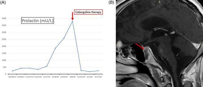 This composite educational image illustrates the diagnosis and treatment response of a pituitary microadenoma. Panel A is a timeline graph displaying plasma prolactin levels (mU/L) over several years. It shows a significant longitudinal increase in prolactin, peaking at approximately 3800 mU/L, followed by a rapid precipitous decline to baseline levels reaching less than 500 mU/L immediately following the initiation of Cabergoline therapy, a dopamine agonist. Panel B is a sagittal T1-weighted magnetic resonance image (MRI) of the brain focusing on the sella turcica. A red arrow indicates a 5 mm hypointense lesion within the pituitary gland, which causes a subtle focal contour abnormality of the gland's superior profile. This finding is characteristic of a pituitary microadenoma. Together, these panels demonstrate the clinical correlation between hyperprolactinemia, neuroradiological evidence of a secretory tumor, and the high efficacy of medical management with dopamine agonists in normalizing hormone levels.