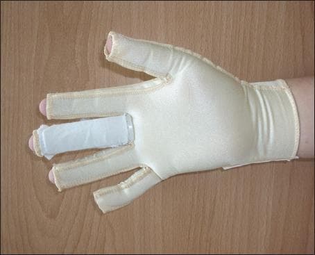 This clinical photograph displays a customized compression garment for the hand, specifically a modified pressure glove designed for burn scar management and rehabilitation. The glove is made of a light-colored, high-stretch elastic fabric with reinforced seams along the fingers and wrist. Two significant modifications are shown: first, 'open window' distal cutouts at the fingertips of all digits to allow for clinical monitoring of distal perfusion and sensation; second, an integrated dorsal pocket on the middle finger containing a shaped thermoplastic splint. This hybrid design combines the therapeutic benefits of continuous compression for scar maturation with the structural support of splinting to prevent joint contractures and maintain finger extension. The clinical focus of this visual is on hand therapy, scar management, and the integration of orthotic devices with compression therapy for improved patient compliance and functional recovery.