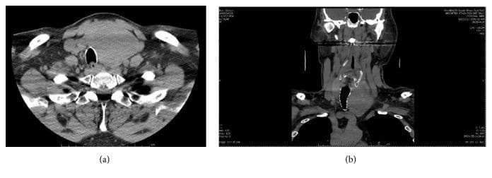 Non-contrast computed tomography (CT) of the neck and superior mediastinum presented in axial (a) and coronal (b) views. The images demonstrate a large, well-circumscribed, heterogeneous soft-tissue mass arising from the left thyroid lobe. In the axial view, the mass causes significant mass effect, resulting in marked rightward tracheal deviation and mild luminal compression. The coronal reconstruction highlights the vertical extent of the lesion, approximately 7.2 cm in sagittal height, showing early substernal extension into the superior mediastinum. The mass is positioned anterior to the vertebral column and displaces the left sternocleidomastoid muscle laterally. The imaging is consistent with a large thyroid goiter or neoplasm, such as Hürthle cell carcinoma, requiring assessment for tracheal patency and potential surgical planning. The surrounding vascular structures and cervical musculature are visible, serving as anatomical landmarks for the extent of the pathology.