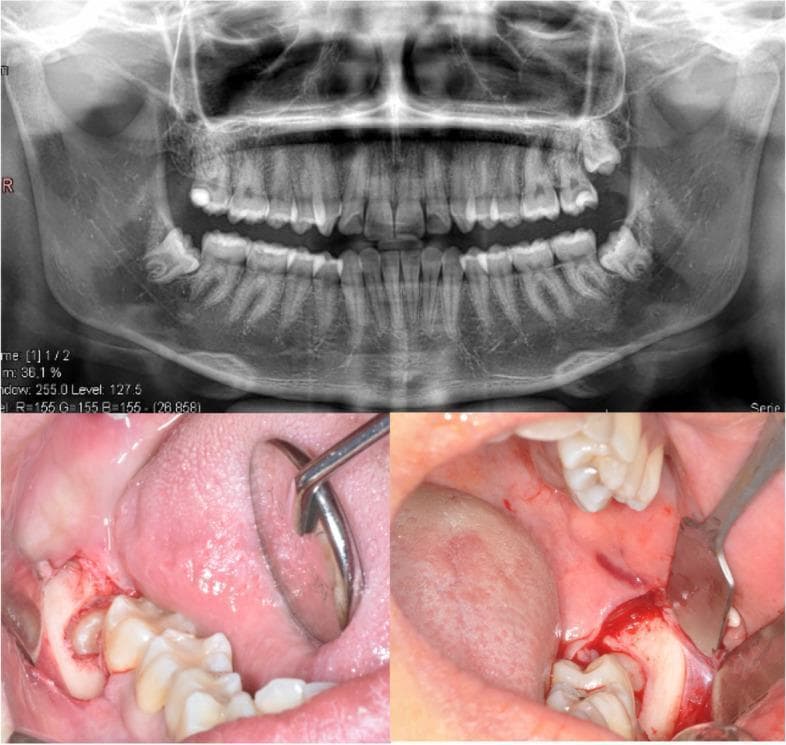 This composite medical image illustrates a clinical case of impacted mandibular third molars and the corresponding surgical intervention. The upper panel displays an orthopantomogram (panoramic radiograph) showing a full permanent dentition. Bilateral, horizontally impacted mandibular third molars (teeth 38 and 48) are clearly visible, with their crowns oriented mesially against the second molars and roots in close proximity to the inferior alveolar nerve canal. The lower panels provide intraoral clinical photographs of the surgical site. The left image shows a reflected full-thickness envelope flap in the mandibular posterior region, utilizing a dental mirror for retraction to expose the partially erupted third molar and surrounding gingival tissues. The right image depicts the active surgical field with further bone removal (osteotomy), showing the exposed crown of the impacted tooth, minor bleeding expected during the procedure, and a periosteal elevator or retractor used to maintain visibility. This image serves as an educational tool for oral and maxillofacial surgery, demonstrating the radiographic diagnosis and initial surgical steps for third molar extraction.