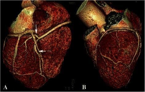 This medical image displays a 3D volume-rendered reconstruction of the heart and coronary arteries derived from cardiac Computed Tomography Angiography (CTA). Panels A and B illustrate the vascular anatomy of a rare congenital anomaly: a single right coronary artery (RCA) with the complete absence of the left coronary artery. In Panel A (posterior-lateral view), the RCA is shown bifurcating into the posterior left ventricular artery (PLVA) and the posterior descending artery (PDA). A black arrow identifies a small, aberrant branch originating from the distal PDA near the posterior cardiac apex. Panel B (anterior-lateral view) demonstrates the distal course of this small branch as it wraps around the apex to terminate on the anterior wall of the left ventricle. This visualization is critical for understanding compensatory collateral circulation and coronary anomalies, specifically how a dominant RCA can provide blood supply to myocardial territories typically served by the left coronary system. The image highlights essential anatomical landmarks, including the cardiac apex and the major posterior coronary branches.