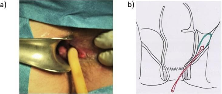 A composite image illustrating the surgical management of a complex perianal abscess. Image (a) is a clinical photograph of a perianal surgical site. A metallic anal retractor is used to visualize the rectal lumen and fistula opening. A yellow, mushroom-tip Pezzer drain is shown inserted through an inter-sphincteric fistula tract to facilitate continuous drainage of deeper infection. Image (b) is a coronal anatomical diagram of the anorectal region. The illustration depicts the rectum, internal and external anal sphincters, and the supralevator space. A green-contoured area highlights a supralevator abscess. A red line represents the Pezzer drain, showing its path originating externally, traversing the inter-sphincteric plane, and terminating within the abscess cavity. The educational focus is on the surgical treatment of supralevator abscesses and the specific placement of self-retaining drains for long-term management of complex fistulous tracts in colorectal surgery.