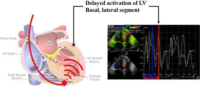 This composite medical illustration demonstrates the pathophysiology of right ventricular (RV) pacing-induced left ventricular (LV) dyssynchrony. The left side features a schematic anatomical diagram of the heart showing the cardiac conduction system (Sinus node, AV node, Bundle branches, and Purkinje fibers). A red line represents a pacing lead traversing the right atrium to the RV apex (marked by a red star). Red wavefront arcs illustrate electrical activation spreading from the RV pacing site to the LV, highlighting the late activation of the LV lateral wall. The right side contains diagnostic images, including a color tissue Doppler echocardiogram and a corresponding velocity-time tracing. The Doppler tracing shows two distinct myocardial velocity curves (green) with vertical blue and red marker lines indicating the significant temporal delay between segmental contractions. A label and arrows point to both the LV basal lateral segment on the diagram and the delayed peak on the Doppler tracing, identifying the mechanical dyssynchrony resulting from the non-physiological electrical sequence of RV apical pacing.