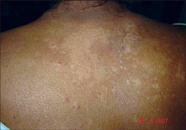 Clinical photograph of a patient's upper back and shoulders showing post-treatment changes of cutaneous sarcoidosis. The skin exhibits a mottled appearance with widespread, irregular areas of hypopigmentation and residual hyperpigmentation. There are visible clusters of light-brown to tan skin tones interspersed with lighter, coalescing patches. A few sparse, small, erythematous papules remain visible, particularly in the lower aspects of the frame. The overall skin texture shows subtle irregularities and resolving surface changes, indicating the healing phase of previously pruritic, coalescent plaques and papules. The image illustrates the clinical outcome following systemic corticosteroid and antimalarial therapy for photosensitive cutaneous sarcoidosis, characterized by significant clearing of active lesions and residual pigmentary alterations.