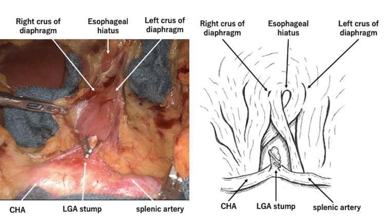 This composite educational graphic features a side-by-side presentation of an intraoperative photograph (left) and a corresponding anatomical line drawing (right) detailing the surgical dissection of the median arcuate ligament. The clinical photograph displays a high-magnification view of the upper abdominal surgical field. Key vascular structures are clearly labeled at the inferior margin, including the common hepatic artery (CHA) and splenic artery bifurcating from the celiac axis, and a ligated left gastric artery (LGA) stump. Superior to these vessels, the esophageal hiatus is shown, flanked by the right and left crus of the diaphragm. The diaphragm's muscular fibers are visible as they form the aortic and esophageal openings. The diagram replicates these relationships, emphasizing the spatial orientation of the celiac trunk branches relative to the diaphragmatic crura. This material is designed to demonstrate surgical anatomy during lymph node dissection and the release of median arcuate ligament syndrome (MALS), providing visual clarity on vascular and diaphragmatic landmarks essential for upper gastrointestinal surgery and esophageal cancer resection.