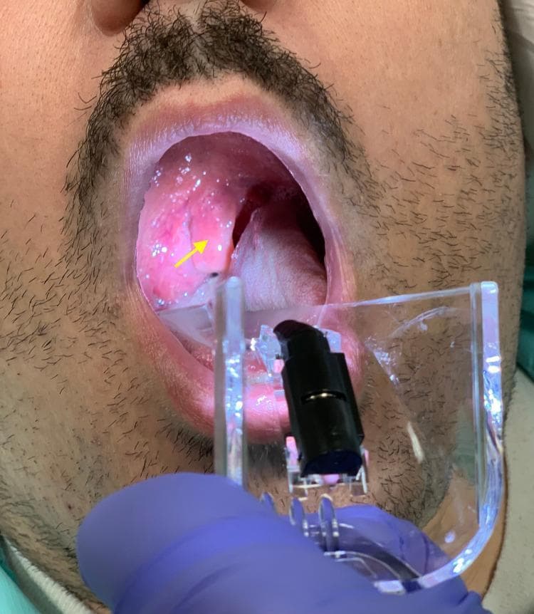 A clinical photograph captures an oropharyngeal examination of a patient using a clear plastic laryngoscope or tongue depressor. The primary finding, indicated by a yellow arrow, is a grossly edematous and erythematous uvula (uvulitis). The uvula is significantly enlarged and swollen, appearing bulbous and distorted, which contributes to significant narrowing of the oropharyngeal airway space. The surrounding mucosa of the soft palate and posterior pharynx exhibits generalized erythema, suggesting acute inflammation. This visual evidence is characteristic of conditions such as Quincke's edema (isolated uvular angioedema) or anaphylaxis-related airway involvement. The palatine tonsils and tongue are visible, with the latter being depressed to allow for a clear view of the upper airway. This image serves as a teaching tool for recognizing emergency airway obstruction signs in otolaryngology and emergency medicine.