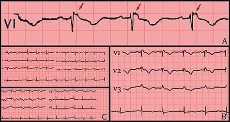 This diagnostic image contains three panels of electrocardiogram (ECG) tracings illustrating the electrical manifestations of Arrhythmogenic Right Ventricular Cardiomyopathy (ARVC). Panel A provides a high-magnification view of lead V1, where red arrows indicate the hallmark Epsilon wave—a low-amplitude notch or 'blip' occurring at the end of the QRS complex and the start of the ST segment. Panel B displays precordial leads V1 through V3, demonstrating a right bundle branch block (RBBB) morphology characterized by widened QRS complexes and persistent T-wave inversions. Panel C presents a standard 12-lead ECG overview following hemodynamic stabilization. The collection emphasizes key diagnostic criteria including repolarization abnormalities (T-wave inversion in V1-V3) and depolarization abnormalities (Epsilon waves). These visual findings are critical for medical students and clinicians in identifying structural right ventricular disease and assessing sudden cardiac death risk.