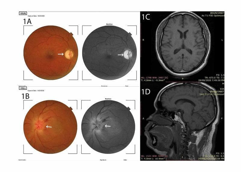 This composite medical image presents diagnostic findings for a case of pseudo-Foster Kennedy syndrome, specifically diabetic papillopathy. Panes 1A and 1B display fundus photography and red-free imaging of the right and left eyes, respectively. Pane 1A (OD) demonstrates a markedly pale, atrophic optic disc (indicated by a white arrow). Pane 1B (OS) shows a significantly edematous and elevated optic disc with blurring of the disc margins and peripapillary retinal hemorrhages, characteristic of acute disc swelling. Panes 1C and 1D provide neuroradiological correlation via T1-weighted Fast Spin Echo (FSE) MRI. Pane 1C shows an axial view at the level of the lateral ventricles, and Pane 1D shows a mid-sagittal view of the brain and orbit. The MRI demonstrates normal intracranial anatomy with no evidence of space-occupying lesions, masses, or increased intracranial pressure, which is critical for differentiating pseudo-Foster Kennedy syndrome from true Foster Kennedy syndrome (typically caused by a frontal lobe tumor). Educational focus includes ophthalmological manifestations of diabetes and neuro-imaging in the differential diagnosis of optic disc edema.