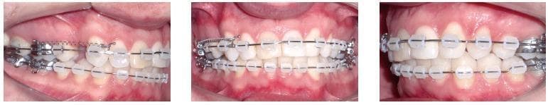 Clinical intraoral photographs showing the orthodontic management of a maxillary arch for space closure following the extraction of tooth #14 (upper right first premolar). The composite image displays lateral and frontal views of fixed orthodontic appliances. A rectangular stainless steel archwire is seated in standard orthodontic brackets across both the maxillary and mandibular arches. The primary educational focus is the 'sliding mechanics' setup on the patient's right side (left side of the image). This includes a hook placed on the archwire distal to tooth #12 (lateral incisor) and a superelastic nickel-titanium (NiTi) closed-coil spring extending from the hook to the molar region (tooth #16). This configuration provides a continuous force (approximately 300g) to close the extraction space by retracting the anterior segment. The clinical scenario demonstrates the alignment, leveling, and space closure phases of treating an Angle Class II, Division 1 malocclusion with tooth-bone discrepancy.