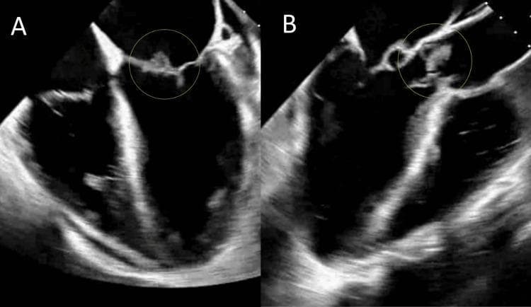 Two side-by-side transesophageal echocardiogram (TEE) images, labeled A and B, demonstrating infective endocarditis with valvular vegetations. Image A shows a grayscale ultrasound view of the mitral valve, with a yellow circle highlighting an irregular, heterogeneously echogenic mass (vegetation) attached to the mitral leaflet. Image B displays the aortic valve region, where a similar yellow circle indicates a lobulated, hyperechoic vegetation adherent to the aortic valve leaflets. Both structures exhibit typical characteristics of cardiac vegetations, including surface irregularities and moderate-to-high echogenicity relative to the myocardium. The surrounding valvular tissue in image B appears more disrupted, consistent with advanced infectious involvement. These diagnostic images are used to illustrate the visual manifestations of infective endocarditis, specifically the identification of vegetations on different heart valves, which are critical for confirming a clinical diagnosis of sepsis secondary to bacteremia.