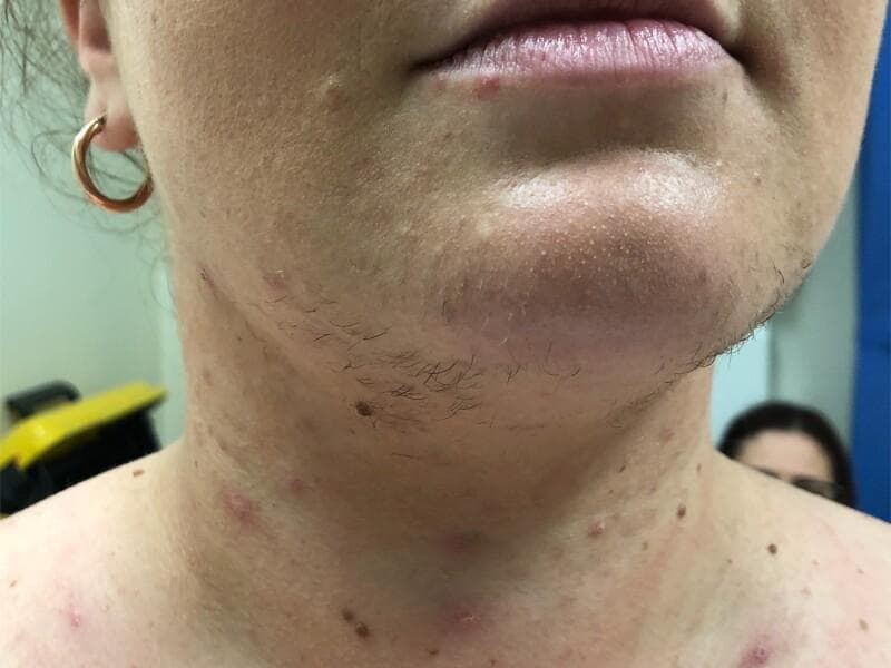 Clinical photograph of the lower face, neck, and upper chest of a female patient exhibiting signs of hyperandrogenism. The primary clinical finding is hirsutism, characterized by coarse, dark, androgenic terminal hair growth in a male-pattern distribution, specifically along the chin, jawline, and submandibular region of the neck. Accompanying dermatological features include inflammatory acne vulgaris, presenting as erythematous papules and pustules scattered across the neck and upper chest. Additionally, there are multiple pigmented macules and small nevi visible on the neck. The skin on the chin demonstrates a slightly thickened and irregular texture, consistent with follicular stimulation. This visual presentation is a key clinical indicator of endocrine dysfunction, such as that seen in polycystic ovary syndrome (PCOS), Cushing syndrome, or androgen-secreting tumors (e.g., adrenocortical carcinoma), where excess androgens stimulate the conversion of vellus hair to terminal hair in androgen-sensitive areas.