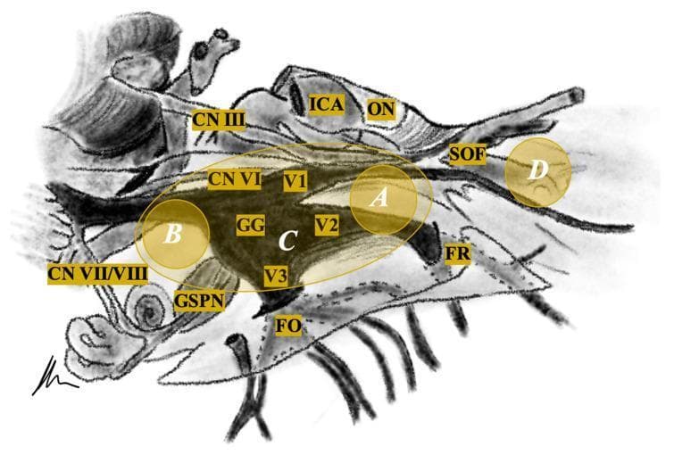 This medical schematic diagram illustrates the neuroanatomical relationships of the trigeminal nerve (CN V) and its surroundings, specifically designed for tumor localization and classification. The central feature is the Gasserian Ganglion (GG), which branches into three divisions: the Ophthalmic (V1) extending toward the Superior Orbital Fissure (SOF), the Maxillary (V2) toward the Foramen Rotundum (FR), and the Mandibular (V3) toward the Foramen Ovale (FO). Adjacent neurovascular structures are labeled, including the Internal Carotid Artery (ICA), Optic Nerve (ON), and Cranial Nerves III, VI, and VII/VIII complex. The Greater Superficial Petrosal Nerve (GSPN) is also indicated inferior to the ganglion. Overlaid on the anatomy are shaded yellow regions and white letters (A, B, C, D) representing a clinical classification system for trigeminal schwannomas: Type A (middle fossa), Type B (posterior fossa), Type C (dumbbell-shaped involving both fossa), and Type D (extracranial/extradural). This diagram serves as a surgical planning guide for neurosurgeons and medical students focusing on skull base pathology.