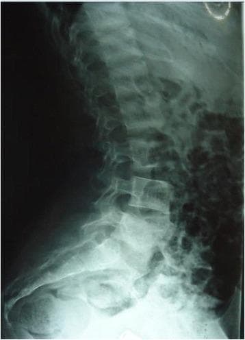 This lateral thoracolumbar X-ray displays a classic 'rugger jersey spine' appearance, a characteristic radiographic sign of osteosclerosis associated with hyperparathyroidism or renal osteodystrophy. The vertebral bodies demonstrate prominent, horizontal bands of increased radiodensity (sclerosis) at the superior and inferior endplates, contrasting with relatively radiolucent (osteopenic) central vertebral bodies. This alternating horizontal pattern mimics the striped design of a rugby jersey. The anatomical region covered includes the lower thoracic spine, lumbar spine, and sacral region. While intervertebral disc spaces appear preserved in height, the pelvic bones visible at the base of the image show heterogeneous bone density. The finding is a critical clinical marker for metabolic bone disease, illustrating the pathological bone remodeling and increased osteoid production that occurs in response to elevated parathyroid hormone levels.