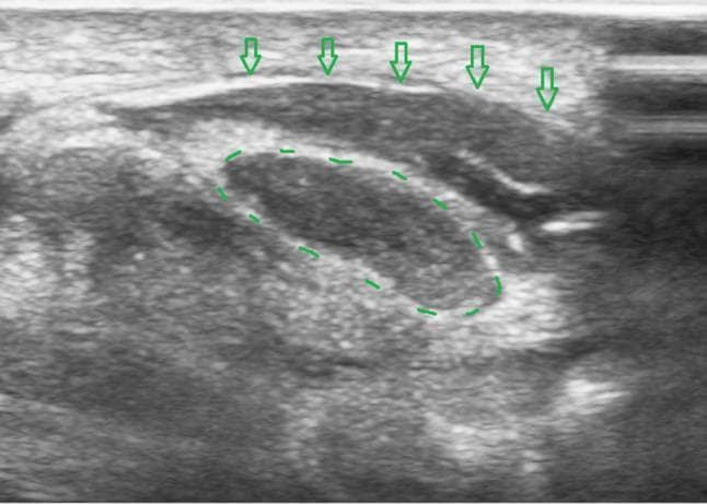 This transverse ultrasound image demonstrates the carpal tunnel during a hydrodissection procedure. In the center, the median nerve is delineated by a dashed green oval, appearing as a characteristic honeycomb-like structure with intermediate echogenicity. Superficial to the nerve, the flexor retinaculum (transverse carpal ligament) is identified by green open arrows as a hyperechoic, linear band. A significant layer of anechoic (black) fluid is visible between the flexor retinaculum and the median nerve, representing the injected solution used to release adhesions. The separation of these structures confirms a successful hydrodissection, creating a distinct space of approximately 4 mm between the deep surface of the retinaculum and the superficial surface of the nerve. This clinical imaging is essential for visualizing the liberation of the median nerve in the treatment of carpal tunnel syndrome, ensuring the nerve is fully adhesiolysed from the overlying ligamentous structures.