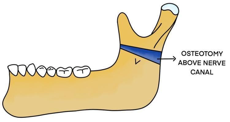 This medical illustration depicts a lateral view of the human mandible, highlighting a surgical modification for treating temporomandibular joint (TMJ) ankylosis. The diagram shows the primary anatomical features of the mandible, including the alveolar ridge with teeth, the mandibular body, and the ramus featuring the coronoid and condylar processes. A highlighted blue band across the upper portion of the mandibular ramus represents a 'Modified Osteotomy Above Nerve Canal.' This specific surgical plane is positioned superior to the inferior alveolar nerve (IAN) canal, which is indicated by a 'v' shaped marking on the ramus. The illustration demonstrates the Esmarch procedure variant where the bone cut is performed high on the ramus to separate the ankylosed condylar unit from the functional mandibular body while aiming to preserve nerve integrity. This anatomical diagram is used to explain surgical planning in maxillofacial surgery, specifically for patients with recurrent joint fusion or altered vascular anatomy.