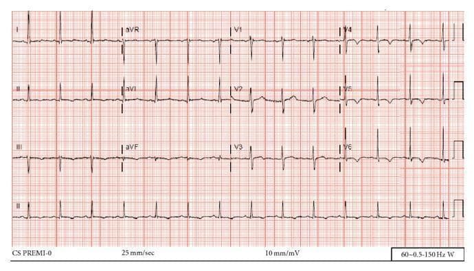 A 12-lead electrocardiogram (ECG) printed on standard grid paper (25 mm/sec, 10 mm/mV) demonstrating diagnostic features of cardiac pathology. The ECG shows a regular rhythm with a heart rate exceeding 100 beats per minute, consistent with sinus tachycardia. Key findings include high-voltage QRS complexes in the precordial leads and limb leads (notably I, II, III, and aVF), which meet voltage criteria for Left Ventricular Hypertrophy (LVH). Additionally, there is prominent T-wave inversion observed in the lateral precordial leads (V4, V5, and V6), a finding that can be associated with LVH 'strain' patterns or myocardial ischemia in the clinical context of aortic dissection and hypertension. The trace displays standard lead placement including limb leads (I, II, III, aVR, aVL, aVF) and precordial leads (V1-V6), with a rhythm strip provided at the bottom (Lead II). This visual is representative of the electrical manifestations of structural heart disease secondary to hypertensive or valvular complications.