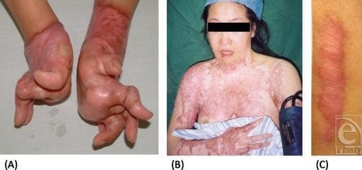 A clinical photograph comparison consisting of three panels (A, B, and C) illustrating different morphological presentations of cutaneous scarring. Panel (A) displays severe burn-related scar contractures of the bilateral hands and wrists. The skin is hyperpigmented, shiny, and thickened, causing fixed deformities and significant functional impairment of the fingers. Panel (B) shows an extensive hypertrophic scar involving a large total body surface area (TBSA), specifically the anterior chest, neck, and right upper extremity. The tissue exhibits a mottled, erythematous, and irregular texture, characteristic of post-burn sequelae. Panel (C) provides a close-up of a linear hypertrophic scar, demonstrating a raised, rope-like, and erythematous appearance against normal skin. This educational visual contrasts localized, linear scars with complex, functionally debilitating scarring, highlighting the limitations of standard scar assessment scales (e.g., VSS, POSAS) in evaluating large-scale or contracture-prone lesions. The content is relevant to dermatology, plastic surgery, and burn rehabilitation.