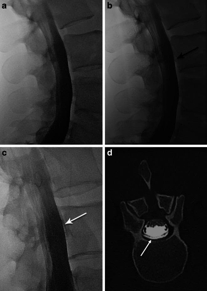 This composite figure illustrates the diagnosis of a cerebrospinal fluid (CSF) leak using dynamic myelography and computed tomography (CT) in a patient with post-dural puncture headache. Panels (a-c) show a temporal sequence of lateral fluoroscopic myelography images in the lumbar spine. Panel (a) demonstrates an initial radiopaque column of contrast medium confined within the thecal sac. Panel (b) reveals the emergence of contrast leakage into the epidural space at the level of the L3 vertebral body (indicated by a black arrow). Panel (c) shows the cranial progression of the extrathecal contrast within the epidural space over time (white arrow). Panel (d) provides a transverse postmyelography CT scan at the lumbar level, confirming the presence of hyperdense contrast medium residing within the epidural space, positioned posterior to the vertebral body and surrounding the thecal sac. This imaging series demonstrates the clinical utility of dynamic myelography in identifying and localizing iatrogenic dural breaches and subsequent epidural CSF collections.