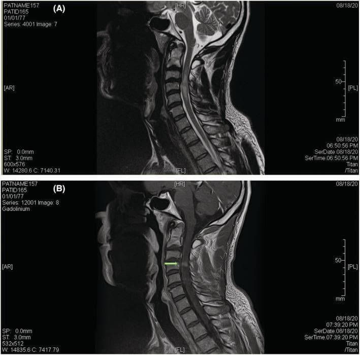 This diagnostic image consists of two sagittal MRI views of the cervical spine illustrating spondylotic myelopathy. Image A is a T2-weighted sagittal MRI showing a long-segment hyperintense signal within the cervical spinal cord, extending from approximately C2-C3 to the C5 level, consistent with cord edema. A degenerative disc bulge at the C3-C4 level is seen mildly indenting the anterior spinal cord. Image B is a T1-weighted sagittal MRI with gadolinium enhancement, which reveals a distinct, linear, transverse band of contrast uptake within the spinal cord just below the level of maximal compression. This finding is known as the 'pancake enhancement pattern' and is a characteristic radiological sign of chronic compressive myelopathy. The imaging highlights key indicators for diagnosing cervical spondylotic myelopathy (CSM) and distinguishing it from other intramedullary pathologies like multiple sclerosis or tumors.