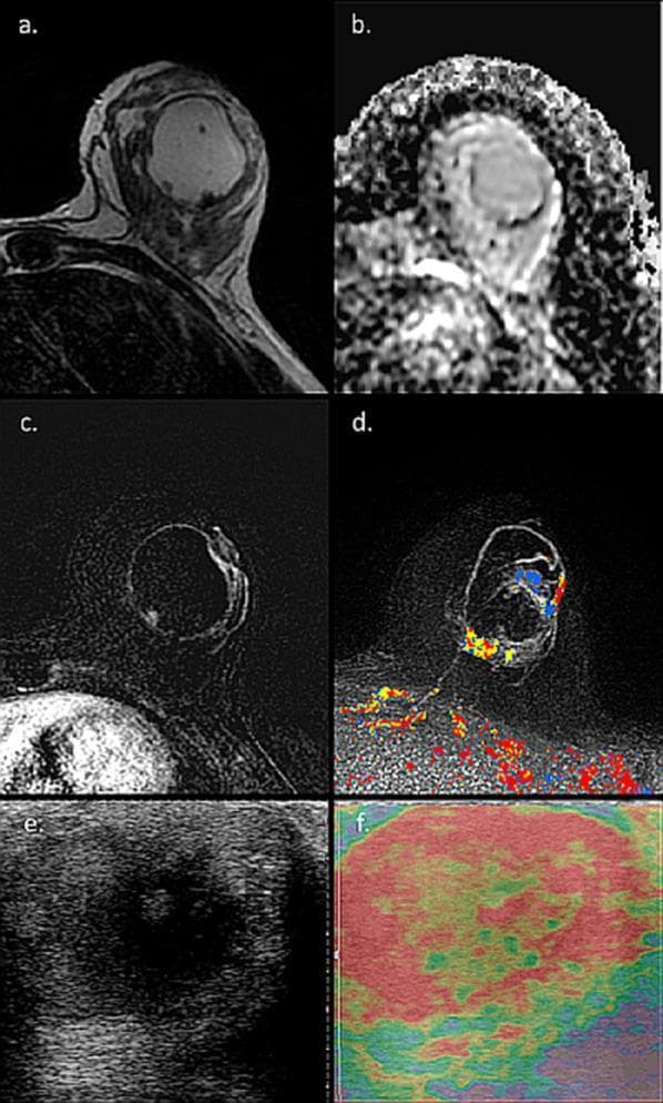 This composite diagnostic image illustrates a case of mammary duct ectasia in a 40-year-old lactating patient, presented through MRI and ultrasound (US) modalities. Panel (a) shows an axial T2-weighted MRI where a large, well-defined cystic structure exhibits high signal intensity. Panel (b) presents the corresponding Apparent Diffusion Coefficient (ADC) map, indicating a lack of internal diffusion restriction within the cyst. Panels (c) and (d) utilize Dynamic Contrast-Enhanced (DCE) and Computer-Aided Diagnosis (CAD) mapping, respectively, revealing distinct rim enhancement along the thick cystic walls amidst background parenchymal enhancement typical of lactation. Panel (e) shows a gray-scale ultrasound image of the 4 cm mass, characterized by thick boundaries and mixed internal echogenicity. Panel (f) provides a static ultrasound elastography map demonstrating significant tissue stiffness throughout the lesion. Together, these images highlight the morphological mimics of malignancy, such as inflammatory breast cancer or abscess, which require US-guided biopsy to confirm the benign diagnosis of duct ectasia in the clinical context of a palpable lactating breast mass.