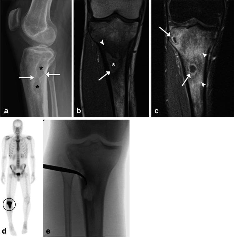 This figure presents a multi-modal imaging series of chronic hematogenous osteomyelitis in the proximal tibia of a 27-year-old male. (a) Lateral radiograph shows irregular lucent areas in the proximal tibia metaphysis (asterisks) with prominent reactive sclerosis (arrows). (b) Coronal T1-weighted MRI demonstrates a well-defined intraosseous abscess (asterisk) exhibiting the 'penumbra sign'—a thin hyperintense rim (arrow) indicative of vascularized granulation tissue—against a background of low-signal reactive sclerosis (arrowhead). (c) Coronal T1 post-contrast fat-saturated MRI reveals peripheral enhancement of the abscesses (arrows) and diffuse, intense enhancement of the adjacent bone marrow (arrowheads), indicating active inflammation. (d) Whole-body bone scan shows a focal area of intense radiopharmaceutical uptake in the right proximal tibia. (e) Intraoperative fluoroscopic image captures the aspiration of purulent material from the osseous pockets. These findings collectively illustrate the classic radiographic and MR features of Brodie’s abscess and chronic osteomyelitis.