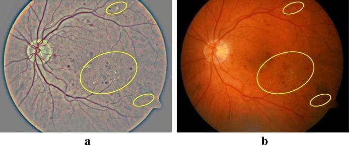 This clinical comparison shows side-by-side retinal fundus photographs demonstrating the effect of contrast enhancement (CE) on the visualization of diabetic retinopathy (DR). Image (a) is the original fundus photograph, presenting a somewhat washed-out, grayish-blue tone with low contrast between retinal features. Image (b) shows the result of the image enhancement technique, featuring a more natural orange-red retinal hue with significantly improved contrast and sharpness. Both images utilize yellow elliptical annotations to highlight specific pathological signs of DR, including hard exudates (bright, yellowish spots) and microaneurysms or small hemorrhages (dark red spots). The optic disc is visible on the left side of each image, with retinal vessels radiating outward. The enhancement in image (b) allows for better singularization and identification of lesions, particularly small microaneurysms and subtle exudates that are less distinct in the raw image. This demonstrates the clinical utility of computational image processing in improving the diagnostic sensitivity of fundus imaging for automated or manual screening.