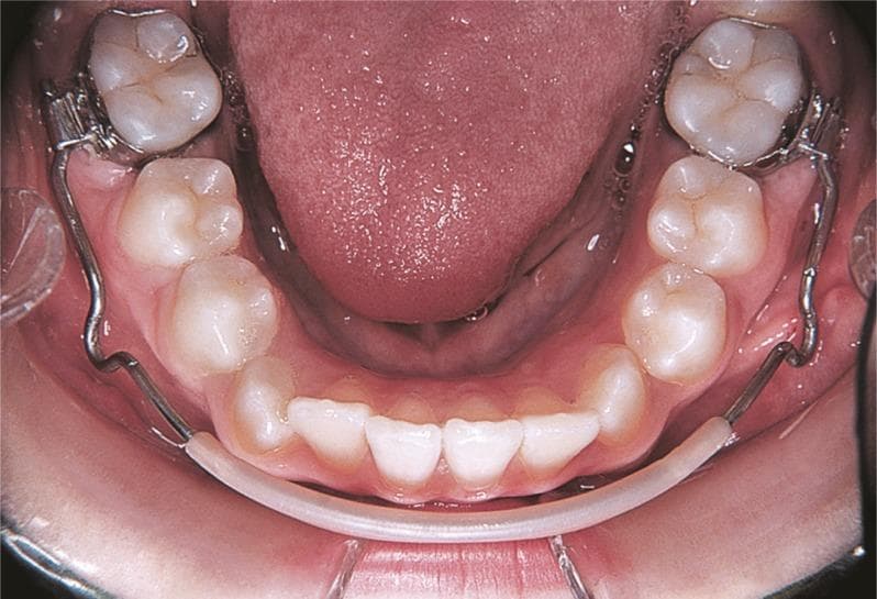 This clinical photograph provides an intraoral occlusal view of a mandibular arch featuring a pre-fabricated lip bumper appliance. The appliance consists of a stainless steel wire framework anchored posteriorly to orthodontic bands on the permanent first molars via specialized molar tubes. Anteriorly, a translucent acrylic shield is integrated into the wire, extending labially from canine to canine. The appliance is positioned to maintain a clear gap (approximately 2–3 mm) between the acrylic shield and the labial surfaces of the lower incisors, as well as a wider clearance (4–5 mm) from the buccal segments. Clinically, this orthodontic appliance is used to harness lip pressure to achieve spontaneous mandibular expansion, distalize or stabilize molars, and gain arch length by preventing the perioral musculature from exerting pressure on the mandibular dentition. The image demonstrates the specific spatial relationship required for the appliance to be active and functional within a pediatric or adolescent orthodontic treatment plan.