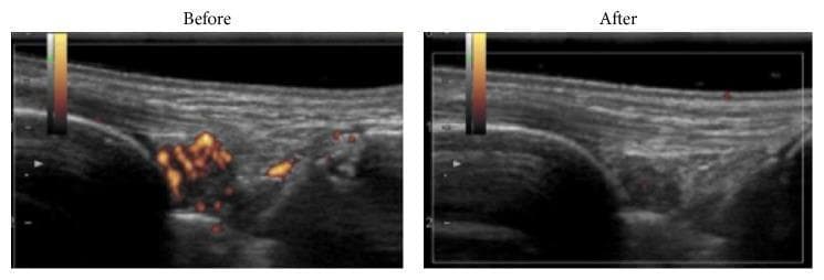 This Comparison Chart displays longitudinal musculoskeletal ultrasound (US) images of a wrist joint before and after treatment for rheumatoid arthritis. The diagnostic imaging utilizes Power Doppler (PD) to evaluate synovial inflammation. In the 'Before' image, there is a prominent, localized area of intense, heterogeneous orange and red color Doppler signals, indicating high-grade active synovitis with increased vascularity. The underlying grayscale image shows irregular, hypoechoic thickening of the synovial tissue. The 'After' image, taken following treatment with the TNF inhibitor certolizumab pegol (CZP), demonstrates a complete disappearance of the PD-positive inflammatory signals. Furthermore, the grayscale appearance shows a reduction in synovial thickening and a more homogeneous tissue texture. This side-by-side comparison illustrates the effectiveness of biologic therapy in achieving clinical and sonographic remission by resolving joint hypervascularity and inflammation.