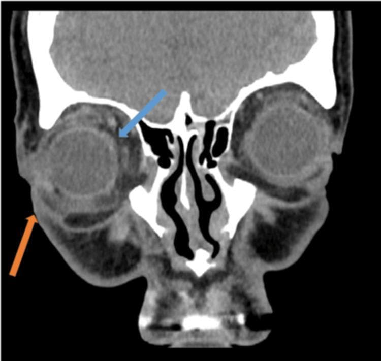 This coronal contrast-enhanced CT scan of the orbits demonstrates clinical features of orbital and periorbital cellulitis. The primary pathological findings include significant stranding of the post-septal orbital fat (indicated by the blue arrow), which appears as increased reticular density within the normally hypodense fat compartment. Additionally, there is marked thickening and increased volume of the periorbital soft tissues (indicated by the orange arrow), consistent with periorbital oedema. The globe is visible, showing signs of mild proptosis relative to the orbital rim. The extraocular muscles and the optic nerve complex are visualized within the inflammatory changes. Bony structures, including the ethmoid air cells and orbital walls, are also depicted. This imaging is characteristic of acute inflammatory or infectious processes within the orbital cavity, illustrating the key diagnostic features necessary to differentiate between pre-septal and orbital cellulitis in a clinical radiology context.