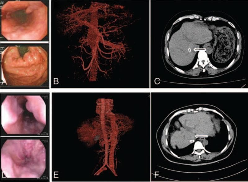 This composite clinical figure presents a comparative study of two patients (Case 1: A-C; Case 2: D-F) undergoing management for portal hypertension and liver cirrhosis. Panels A and D show endoscopic views of the middle/lower esophagus and gastric fundus, identifying prominent, tortuous varicose veins (esophageal and gastric varices) and signs of portal hypertensive gastropathy. Panels B and E demonstrate 3D reconstructed abdominal angiographies (CT angiography), highlighting significant vascular abnormalities including a widened portal vein, collateral venous circulation around the stomach and spleen, and abnormal perfusion shadows in the right hepatic lobe. Panels C and F are axial abdominal CT scans obtained after transjugular intrahepatic portosystemic shunt (TIPS) placement. White arrows in the CT images indicate the successful positioning of the intrahepatic stents within the liver parenchyma, designed to decompress the portal pressure. The images collectively illustrate the diagnostic progression from direct visualization of varices to vascular mapping and post-interventional radiological verification of shunt placement in patients with complications of chronic liver disease.