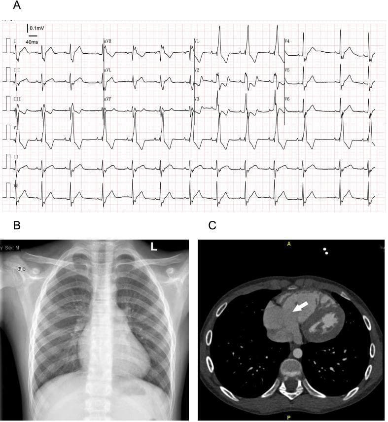 A multi-panel medical diagnostic image set illustrating cardiac findings in a patient with Ebstein's anomaly. Panel A displays a 12-lead electrocardiogram (ECG) demonstrating signs of arrhythmia and a complete right bundle branch block (RBBB), characterized by widened QRS complexes and classic RSR' patterns in precordial leads. Panel B is a posterior-anterior chest radiograph (X-ray) showing prominent enlargement of the right heart border, indicative of right atrial dilation, while the lung fields remain clear and the cardiothoracic ratio is measured at 0.5. Panel C shows an axial contrast-enhanced CT scan of the thorax at the level of the four-chamber view. A white arrow points to the significant enlargement of the tricuspid annulus, a key diagnostic feature of the valvular pathology. This composite figure serves as a diagnostic educational tool for identifying the multi-modality presentation of congenital tricuspid valve malformations and associated right-sided cardiac remodeling.