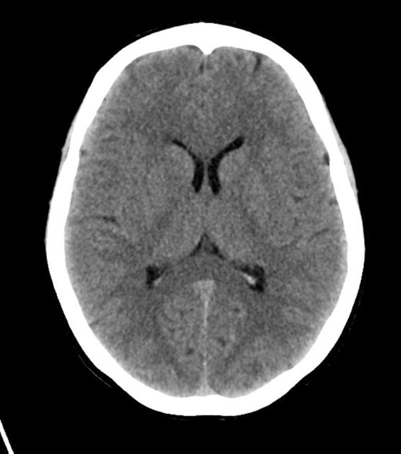 This diagnostic image is an axial non-contrast Computed Tomography (CT) scan of the brain, demonstrating normal anatomy at the level of the basal ganglia and lateral ventricles. The brain parenchyma shows appropriate attenuation with preserved gray-white matter differentiation. Key anatomical structures visible include the frontal horns of the lateral ventricles, which are symmetric and non-dilated, and the midline falx cerebri. The basal ganglia and thalamus appear unremarkable, without signs of hemorrhage, mass effect, or focal ischemia. The sulci and subarachnoid spaces are normal for age, and the overlying calvarium is intact without fractures. This imaging is used in clinical education to demonstrate a normal neurological study in patients presenting with altered mental status (AMS), specifically to rule out intracranial pathology such as stroke, trauma, or space-occupying lesions, thereby pointing toward metabolic etiologies like alkalosis.