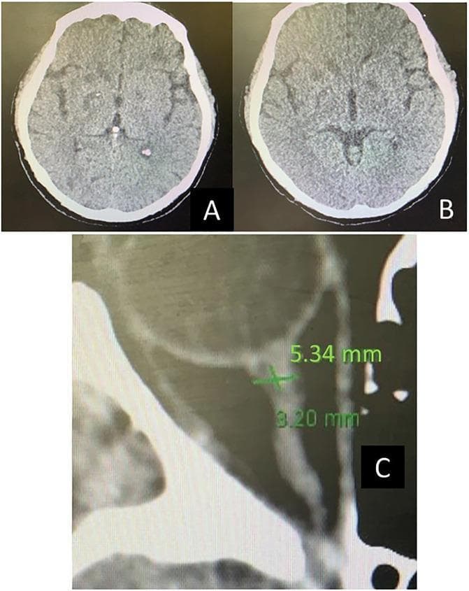 Educational clinical image panel consisting of axial non-contrast brain computed tomography (CT) scans and a diagnostic measurement of the ocular anatomy. Panel A shows an initial axial head CT with evidence of diffuse cerebral edema, characterized by a loss of gray-white matter differentiation and effacement of the cortical sulci. Panel B, a follow-up CT scan on day 4, demonstrates interval resolution of the edema, with improved visualization of brain parenchyma, sulcal spaces, and clearer gray-white matter boundaries. Panel C displays a zoomed diagnostic CT image of the orbit, illustrating a measurement of the optic nerve sheath diameter (ONSD). A transverse green caliper indicates an abnormal ONSD measurement of 5.34 mm, a finding clinically significant as an indirect marker for increased intracranial pressure (ICP). This set of images illustrates the radiological progression and monitoring of intracranial hypertension and brain compliance in an intensive care setting.
