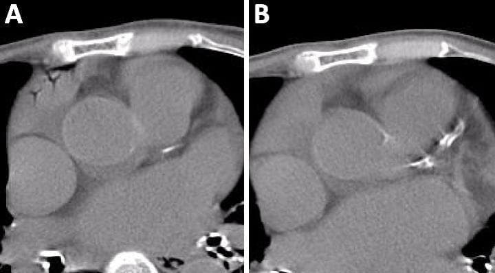 This diagnostic comparison contains two axial non-contrast chest CT scans (Figure 1A and 1B) illustrating an intracardiac air embolism. Figure 1A, an electrocardiography-asynchronized CT, demonstrates the 'Mercedes-Benz sign' in the right atrium. This sign is characterized by linear, low-attenuation (dark) gas collections within the atrial lumen, branching into a configuration reminiscent of the Mercedes-Benz logo. The appearance is a dynamic artifact caused by the movement of air during the cardiac cycle in a non-synchronized acquisition. Figure 1B shows a follow-up CT of the same anatomical region taken two days later, which reveals complete resolution of the intracardiac air, with the right atrium now exhibiting homogeneous soft-tissue density. This clinical comparison is used to teach the recognition of venous air embolisms, which can occur as a complication of peripheral venipuncture, and highlights the importance of imaging timing and technique in detecting transient gas within cardiac chambers.