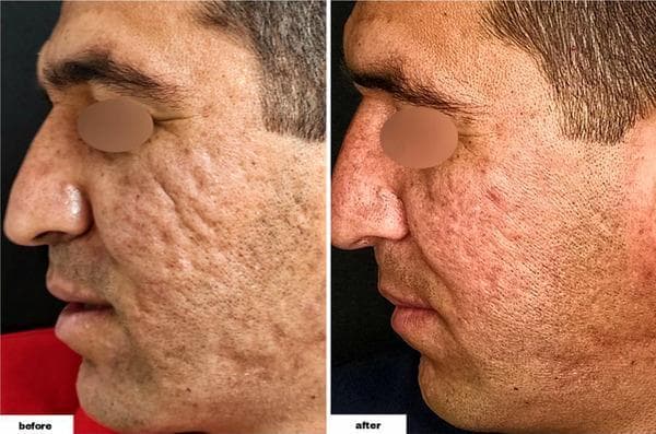 Comparison clinical photographs of a 34-year-old male patient's profile, showing the 'before' and 'after' results of an acne scar revision procedure. The 'before' image displays severe atrophic acne scarring on the left cheek, characterized by a combination of deep ice-pick, rolling, and boxcar lesions that create an undulating, pitted skin texture. Multiple hyperpigmented macules and enlarged pores are visible throughout the malar region. The 'after' image demonstrates a significant improvement in dermal contour and skin surface regularity. There is a visible reduction in the depth and shadow of the depressed scars, alongside a decrease in the number of active-appearing inflammatory lesions and pigmented blemishes. The treated area shows mild post-procedural erythema and a more uniform skin tone. This comparison serves as a clinical illustration of therapeutic efficacy in treating persistent facial scarring and post-inflammatory changes in adult male skin.