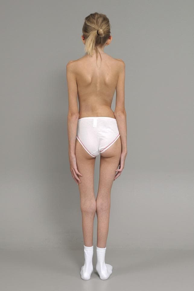 A clinical photograph displaying the posterior view of a pediatric patient, illustrating a marfanoid habitus characterized by a tall stature, slender build, and arachnodactyly with disproportionately long limbs relative to the torso. The primary musculoskeletal finding is a visible scoliosis, presenting as a lateral curvature of the spine. Key clinical features include asymmetrical waist triangles, trunk shift, and slight pelvic obliquity. This visual is highly representative of connective tissue disorders such as Marfan syndrome, where skeletal abnormalities including progressive spinal curvature and elongated extremities are common. The image serves as an educational resource for identifying marfanoid body habitus and secondary orthopedic manifestations like scoliosis during a clinical physical examination.