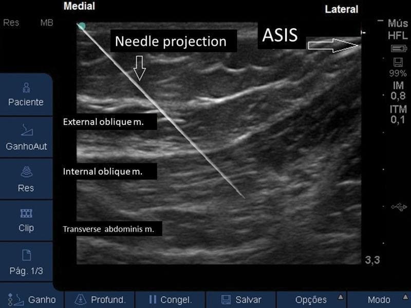 This diagnostic ultrasound image demonstrates the anatomy of the anterolateral abdominal wall for an ultrasound-guided regional anesthesia procedure, specifically an Ilioguinal/Iliohypogastric (II/IH) nerve block. The cross-sectional view displays three distinct muscle layers from superficial to deep: the external oblique, internal oblique, and transverse abdominis muscles. The muscles appear as relatively hypoechoic bands separated by bright, hyperechoic fascial planes. Laterally, the anterior superior iliac spine (ASIS) is identified as a hyperechoic bony landmark. A needle is visualized in-plane, appearing as a sharp, linear hyperechoic structure. It follows a medial-to-lateral trajectory, with its tip precisely positioned in the neurovascular fascial plane between the internal oblique and the transverse abdominis muscles. This placement is clinically significant for the delivery of local anesthetic to target the nerves supplying the lower abdominal wall. The image serves as an educational guide for identifying relevant landmarks and verifying correct needle tip placement during interventional pain management or surgical anesthesia.