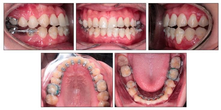 A composite of five intraoral clinical photographs documenting orthodontic treatment for space closure in a 24-year-old male. The images include frontal, lateral (right and left), and occlusal views (maxillary and mandibular) of the dental arches. The mandibular arch demonstrates active space closure using a combination of labial and lingual mechanics. Key components include metallic molar bands, brackets, and a stainless steel archwire. Power chains (elastic chains) are visible extending from the mandibular right second molar to the mandibular left third molar on both the labial and lingual surfaces to manage space and prevent unwanted rotation or bowing. Clear composite buttons are bonded to the labial surfaces of the mandibular canines to facilitate elastic attachment. A segmental archwire is utilized in the lower right quadrant between the second premolar and second molar. The frontal view shows a slight anterior open bite and midline discrepancy. The occlusal views reveal the lingual appliance setup and the extraction sites undergoing closure. Gingival health appears stable with no significant inflammation visible.