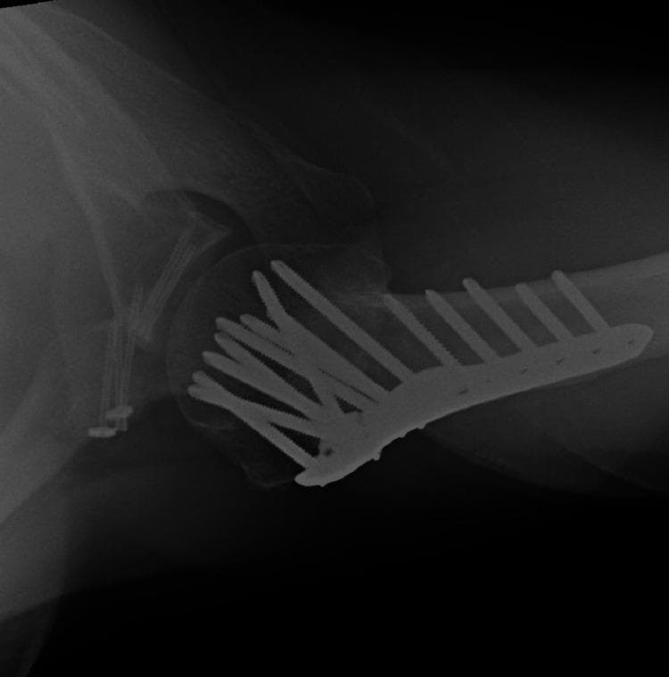 Postoperative axial radiograph of the left shoulder demonstrating complex orthopedic internal fixation for a multi-part fracture involving the proximal humerus, glenoid, and coracoid process. A large, contoured proximal humeral locking plate (PHILOS) is visible on the lateral humerus, secured with multiple divergent locking screws into the humeral head in a fan-like configuration and several bicortical screws along the humeral shaft. On the scapular side, at least two cannulated screws are visible traversing the anterior glenoid rim to stabilize an anterior glenoid fragment. Additional fixation is noted near the coracoid process with screws and washers. The image shows evidence of successful fracture union at 14 months post-surgery, with the glenohumeral joint maintaining a concentric, reduced position. This radiograph illustrates surgical management for high-energy shoulder trauma involving complex fracture-dislocation or 'floating shoulder' variants.