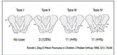 This medical illustration depicts the Torode and Zieg classification system for pediatric pelvic fractures, specifically demonstrating four distinct types of injury severity. Type I represents avulsion fractures (small dashed lines at bony prominences); Type II shows an isolated fracture of the iliac wing without pelvic ring instability; Type III depicts a simple pelvic ring fracture, typically involving the pubic ramus; and Type IV illustrates unstable fractures with complete disruption of the pelvic ring in multiple locations, including displacement. The diagram uses anatomical line drawings of the adult-like pelvis for clarity, with directional arrows and dashed lines indicating fracture sites and force vectors. Below the illustrations, clinical frequency data is provided, showing the distribution of cases among the various types. This anatomical diagram serves as a diagnostic and classification tool for orthopedic surgery and pediatric trauma management, emphasizing the progression from stable, localized injuries to complex, unstable ring disruptions.
