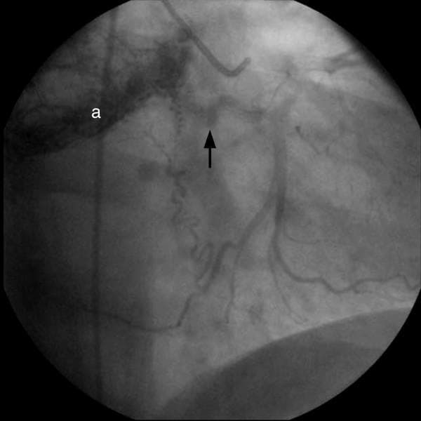 This diagnostic image is a coronary angiogram obtained during cardiac catheterization, showing the left coronary artery system. The visual focus is on the left circumflex (LCx) artery, indicated by a black arrow. Distinct from normal coronary anatomy, there is evidence of pathologically significant neovascularization, characterized by multiple small, tortuous, and irregular vessels branching from the LCx. These vessels lead to a discrete area of intense contrast enhancement, or 'tumor blush' (labeled 'a'), located in the proximity of the heart. This finding is indicative of a hypervascular mass, such as a cardiac paraganglioma, which is recruiting blood supply from the coronary circulation. The image demonstrates the use of angiography in identifying extrinsic or intrinsic cardiac tumors based on their vascular signatures and feeding vessel origins. It serves as an educational example of how coronary neovascularization and tumor blushes appear in clinical imaging for cardiac oncology and cardiology diagnostics.