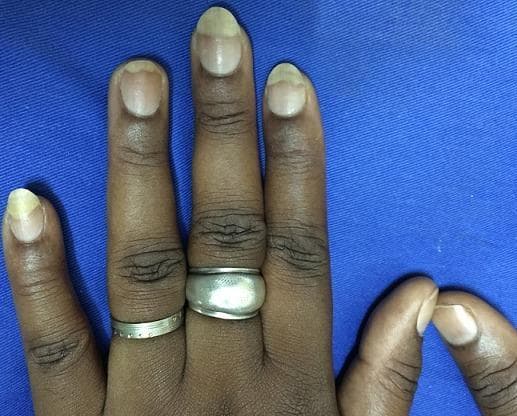A clinical photograph of a person's hand on a blue background, demonstrating distal leuconychia (whitening of the distal nail plate). The image shows several fingers where the distal half to third of the nail plate exhibits a prominent, opaque white or pale discoloration. This is clearly demarcated from the proximal portion of the nail plate, which maintains a normal, pinkish translucency. This specific pattern of nail discoloration is a documented complication following the application and removal of artificial nails, often associated with chemical exposure to adhesives like methyl cyanoacrylate or mechanical trauma to the nail surface. The subject has a dark skin tone (Fitzpatrick type IV-VI), and visible features include skin wrinkling over the interphalangeal joints and decorative rings on the second and third fingers. This visual serves as an educational example of chemical or traumatic nail plate dystrophy in the context of cosmetic nail procedures.