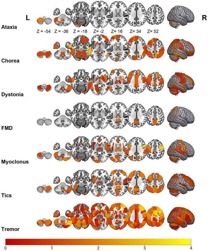 This diagnostic image provides a comparative overview of resting-state fMRI (rs-fMRI) alterations in Hyperkinetic Movement Disorders (HMD). It displays axial slices and 3D surface-rendered brains for seven phenotypes: Ataxia, Chorea, Dystonia, Functional Movement Disorder (FMD), Myoclonus, Tics, and Tremor. The visualization utilizes ALFF (Amplitude of Low-Frequency Fluctuations) and ReHo (Regional Homogeneity) analysis methods. A heat map scale at the bottom (0 to 4) indicates the degree of regional involvement based on the standardized mean difference (SMD), with colors progressing from deep red (lower involvement) to bright yellow (higher involvement). Key observations include primary cerebellar involvement in Ataxia; widespread cortical and subcortical alterations in Chorea and Tremor; and prominent sensorimotor cortex involvement in Dystonia. Tremor exhibits the most extensive and intense alterations across both hemispheres, including the cerebellum and cerebral cortex. FMD shows more localized cortical changes, while Tics demonstrate involvement in the frontal cortices and basal ganglia structures. This educational visualization assists in identifying neuroanatomical signatures and commonalities, such as cerebellar-thalamo-cortical pathway dysfunction, across different movement disorders.