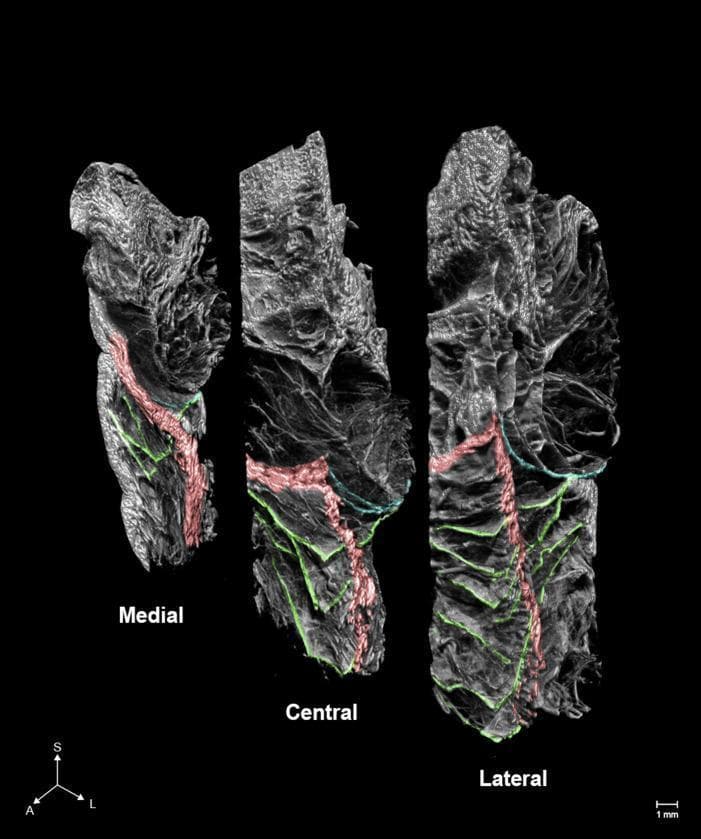 This diagnostic image consists of three high-resolution micro-computed tomography (microCT) slices depicting the anatomical architecture of the periorbital region in the medial, central, and lateral planes. The visual highlights the orbicularis retaining ligament (ORL) and its spatial relationship with adjacent structures using false-color overlays. The ORL (green) is shown as a complex network of multilayered plexiform fibers that arborize horizontally. The image demonstrates a progressive increase in the number, complexity, and branching of ORL fibers from the medial to the lateral aspect. The orbital septum is highlighted in blue, while sections of the orbicularis oculi muscle are indicated in red. The spatial arrangement reveals the ORL is positioned anterior to the orbital septum and interweaves with the muscle fibers of the orbicularis oculi. Anatomical orientation is provided by an axis indicator showing Superior (S), Anterior (A), and Lateral (L) directions, along with a 1 mm scale bar. This content is used to illustrate the delicate ligamentous structures involved in facial aging and surgical rejuvenation.