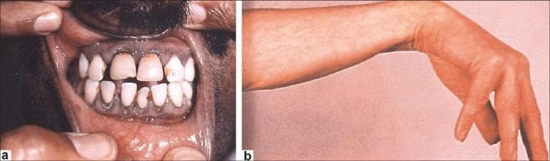 This composite clinical photograph displays two classic physical manifestations of chronic lead poisoning (plumbism). Figure 1a is an intraoral photograph showing the maxillary and mandibular gingiva. A prominent Burtonian line (lead line) is visible as a dark, bluish-gray discoloration along the gingival margin, resulting from the reaction of circulating lead with sulfur-producing bacteria. Secondary findings include dental caries and poor oral hygiene. Figure 1b is a clinical photograph of a patient's forearm and hand demonstrating 'wrist drop' (radial nerve palsy). The wrist is in a flexed position due to paralysis or significant weakness of the extensor muscles, an indication of lead-induced peripheral neuropathy. These images serve as educational tools for recognizing systemic heavy metal toxicity through dermatologic, oral, and neurological physical examination findings. The clinical context relates to occupational exposure and the resulting neuromuscular and mucosal pathology.