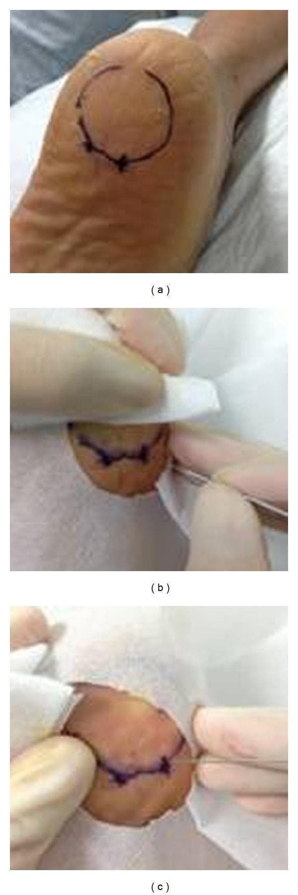 This composite of clinical photographs illustrates the surgical procedure for miniscalpel-needle (MSN) release treatment for plantar fasciitis. Panel (a) shows the plantar aspect of a human heel with a circular surface landmark and 'X' markings used to identify the most painful tender point over the medial tubercle of the calcaneum. Panel (b) depicts the intraoperative phase where a 0.80 mm diameter MSN is inserted vertically into the marked tender point while the patient is in a prone position. The clinician's gloved hands are visible managing the surgical field. Panel (c) shows the immediate post-procedure result, demonstrating a small, linear puncture wound at the insertion site with minimal local skin trauma. The series highlights a minimally invasive approach to musculoskeletal pain management, specifically targeting the release of thickened plantar fascia under local anesthesia. The educational focus is on the localization of anatomical landmarks and the technique for needle-based surgical intervention in chronic heel pain.