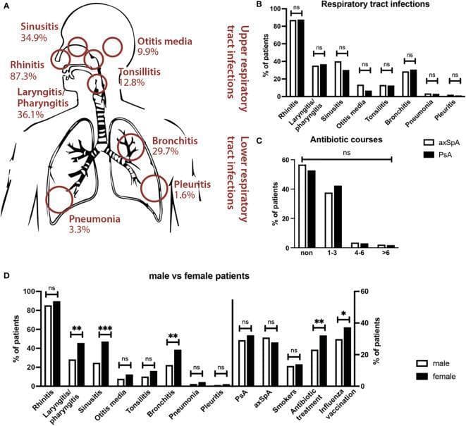 This medical infographic displays data on respiratory tract infections (RTIs) in patients with spondyloarthritis (SpA). Panel A utilizes an anatomical diagram of the human respiratory system to map the frequency of specific infections. Upper respiratory tract infections (URTIs) shown include rhinitis (87.3%), laryngitis/pharyngitis (36.1%), sinusitis (34.9%), tonsillitis (12.8%), and otitis media (9.9%). Lower respiratory tract infections (LRTIs) include bronchitis (29.7%), pneumonia (3.3%), and pleuritis (1.6%). Panel B provides a bar chart comparing RTI frequencies between axial spondyloarthritis (axSpA) and psoriatic arthritis (PsA) cohorts, showing no significant differences. Panel C illustrates the distribution of antibiotic courses prescribed, categorized by patient subgroup. Panel D presents a sex-disaggregated analysis, revealing that female patients (black bars) report significantly higher rates of laryngitis/pharyngitis, sinusitis, and bronchitis compared to male patients (white bars), alongside higher rates of antibiotic treatment and influenza vaccination. The graphic effectively summarizes the epidemiological burden of RTIs within these chronic inflammatory disease populations, highlighting gender-specific variations and clinical management patterns.
